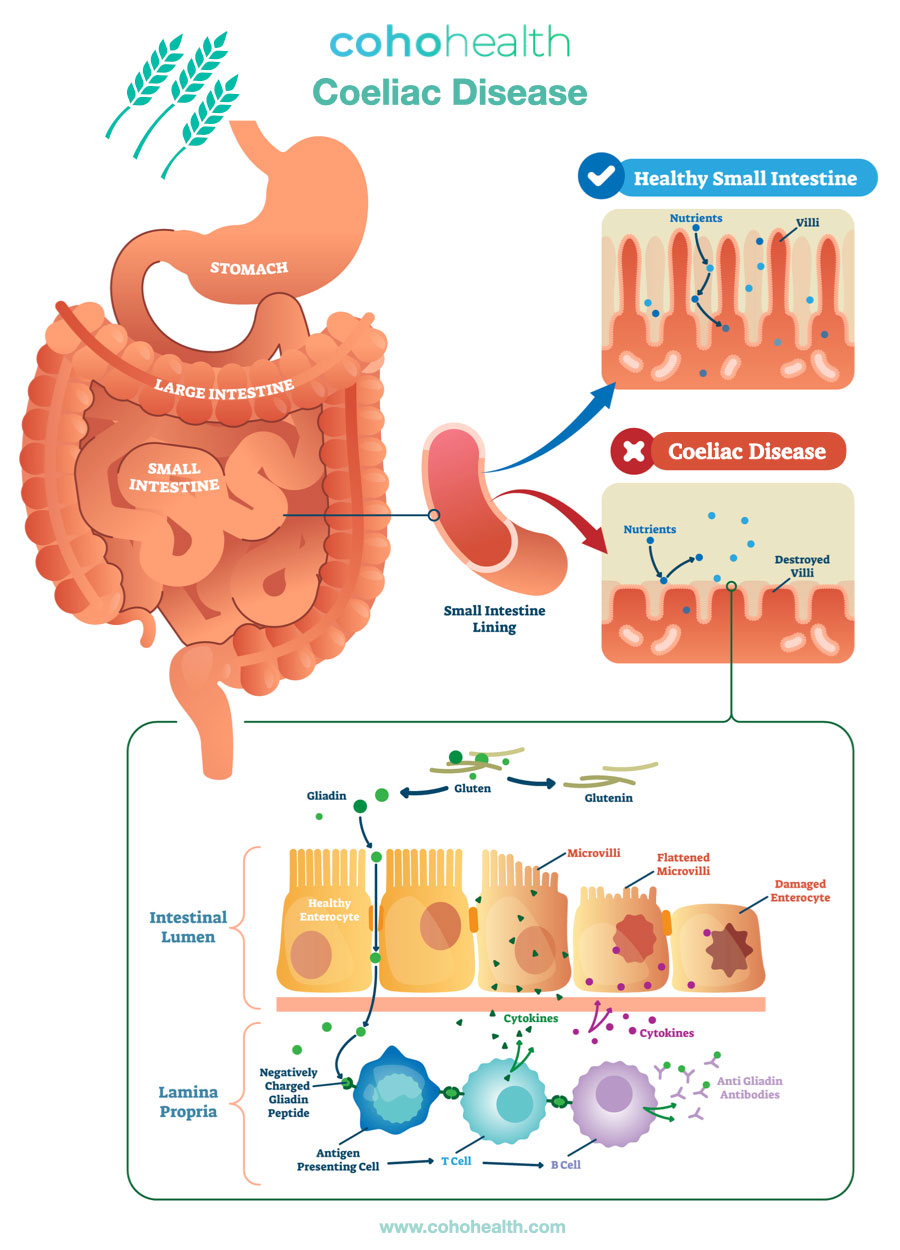Functional medicine approach to celiac disease